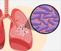 Ce este tuberculoza ?